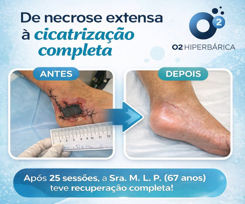 Comparação antes e depois de uma complicação pós-cirúrgica no calcâneo, conforme relato da O2PA após 25 sessões de OHB