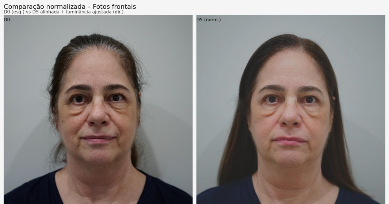 Comparação frontal fornecida pela autora: antes do início à esquerda e após 5 sessões à direita