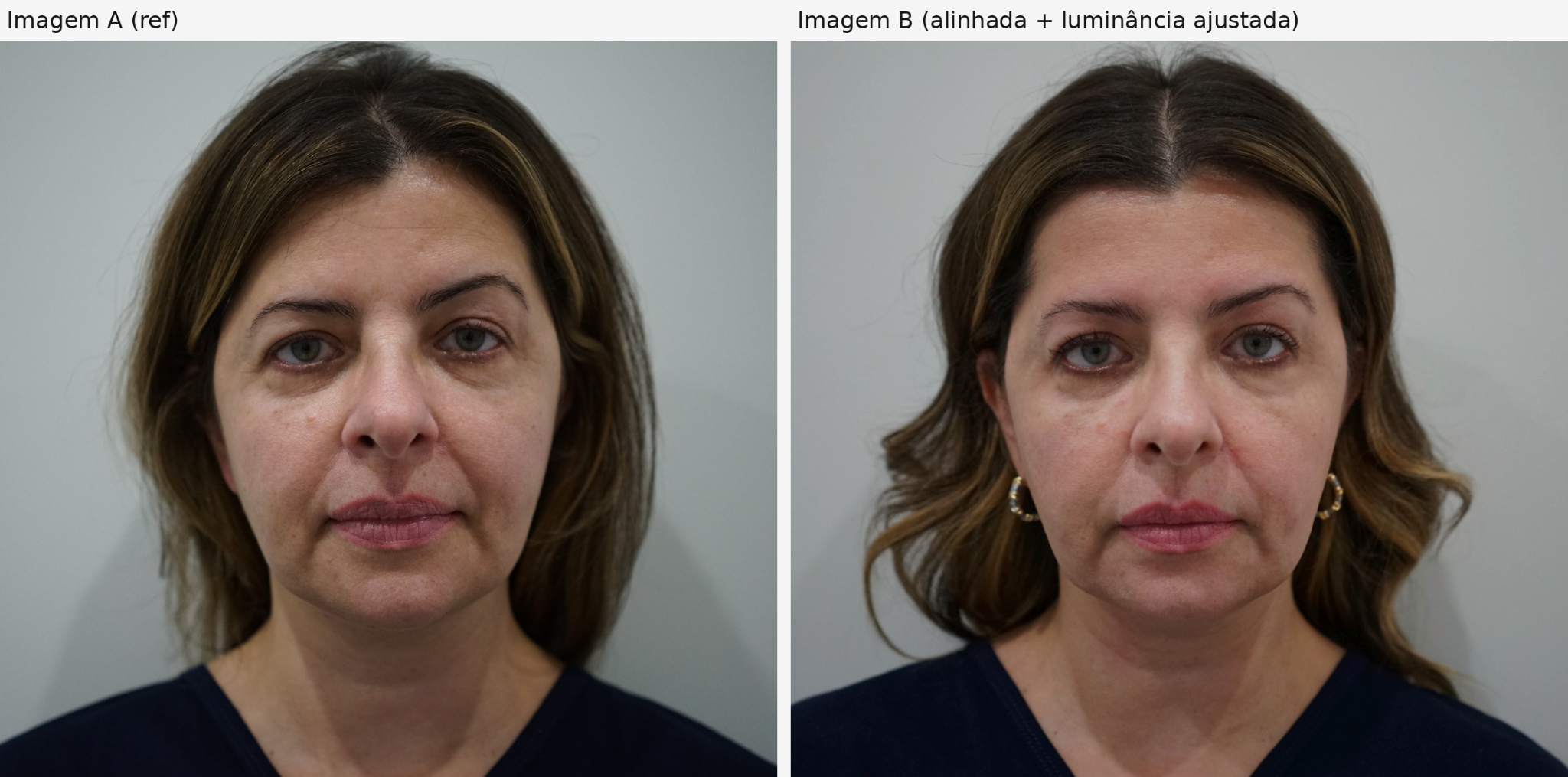 Comparação frontal: D0 antes do início à esquerda e D10 após 10 sessões à direita; imagem B alinhada e com luminância ajustada